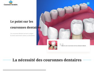 Qu’est ce que la couronne dentaire?